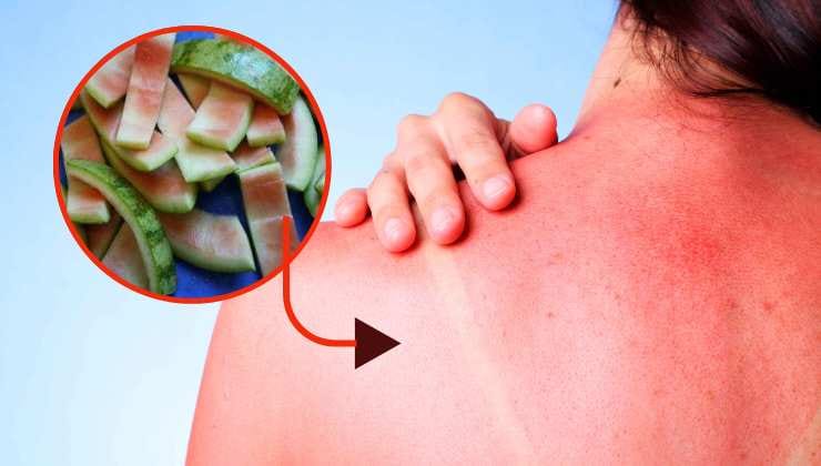 Bucce del cocomero per scottature solari Cáscaras de sandía para quemaduras solares